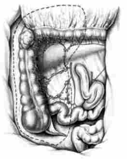 ����� �������� (��������������� ������������) ��� ���� ����������� ������ ������� �����